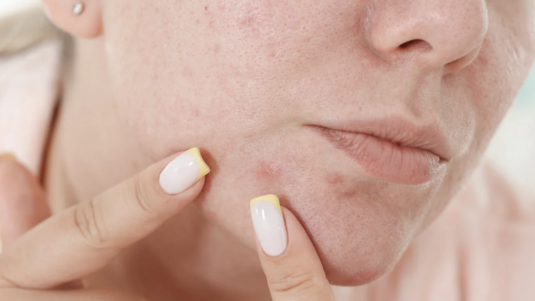 Acne Facial Medical Spa Appointment Near Sterling, Virginia